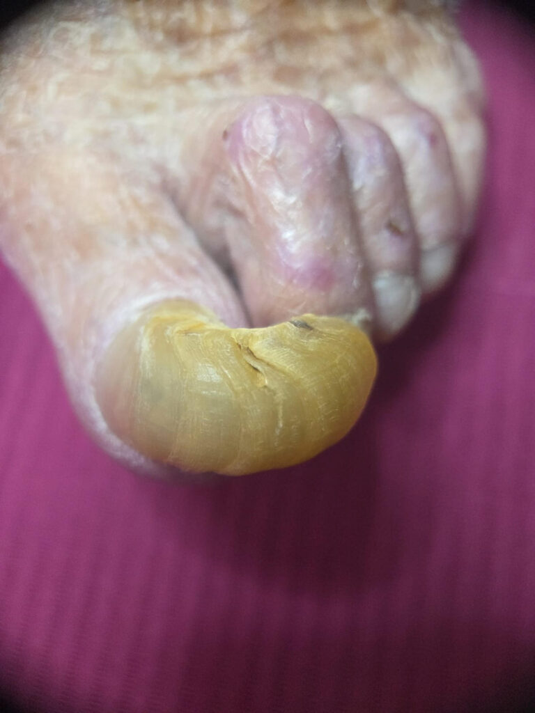 stopa cukrzycowa