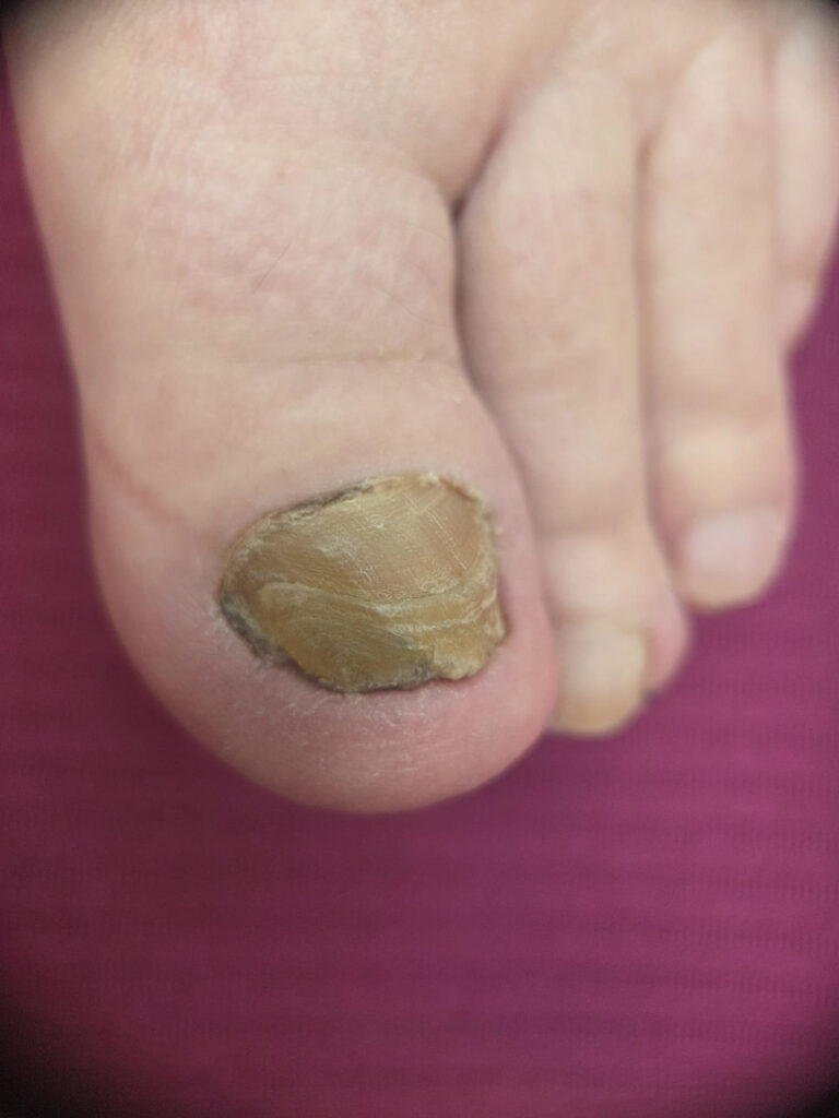 grzybica paznokcia